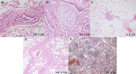 Adult bronchiolitis – A clinical and pathological interpretative classification | Pulmonology