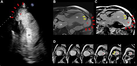 Progression of Left Ventricular Aneurysm to Pseudoaneurysm on Serial ...