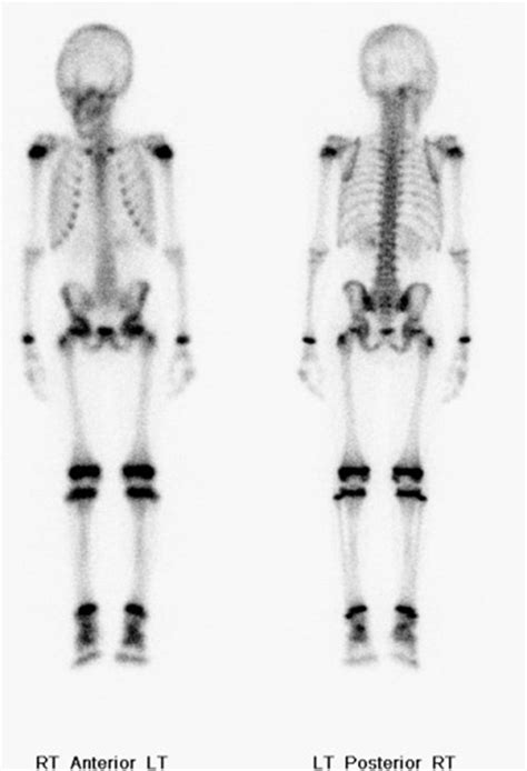 Image result for Normal Bone Scan