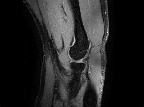 Fat-free elbow imaging | Philips MR Body Map