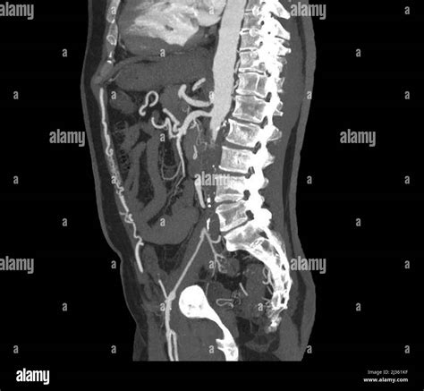 Aortoiliac occlusive disease, CT angiogram Stock Photo - Alamy