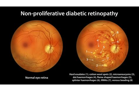 Can Diabetic Retinopathy Be Reversed