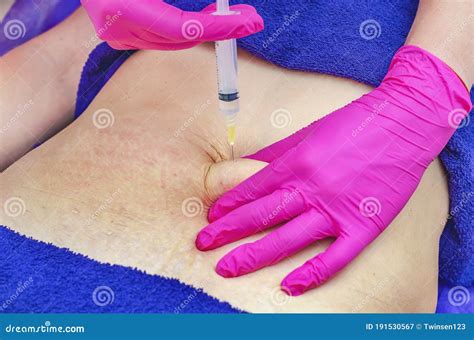 Abdominal Injections To Smooth Out Stretch Marks after Childbirth ...