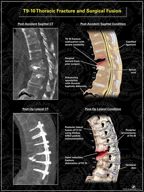 T9-10 Thoracic Fracture and Surgical Fusion