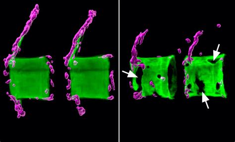 Neue Strategie gegen Osteoporose | Quintessenz Verlags-GmbH