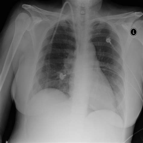 Image result for Tuberculosis Dataset CSV