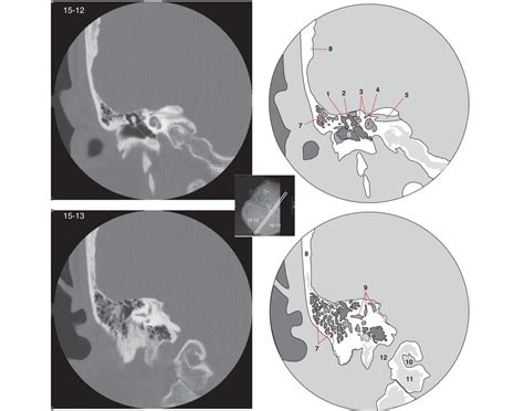 CT Temporal Bones Quiz