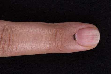 Sinal De Hutchinson Melanoma - RETOEDU