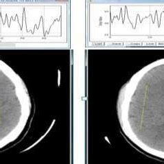 Image result for Normal Profile CT
