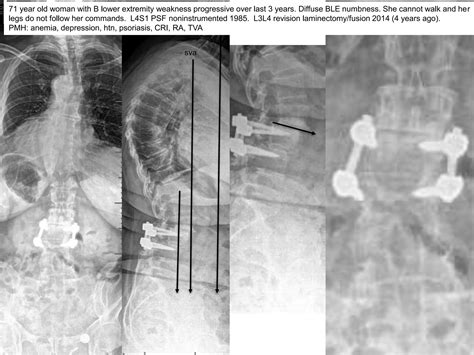spine Lecture pso | PPTX