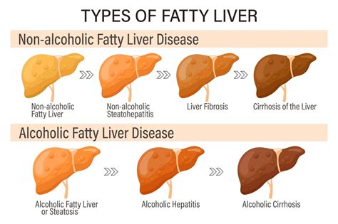 Types of fatty liver. Human liver diseases. Alcoholic and non-alcoholic ...