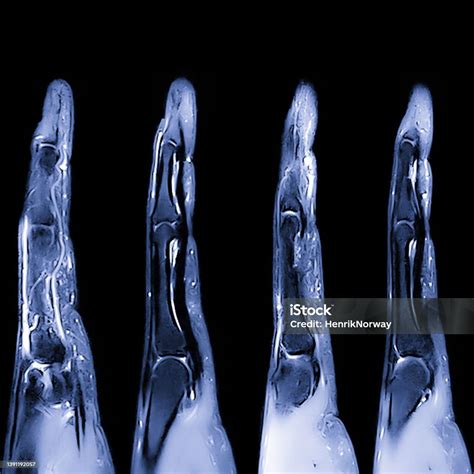Mri Xray Image Of A Hand And Fingers With Bones Muscle And Tissue ...