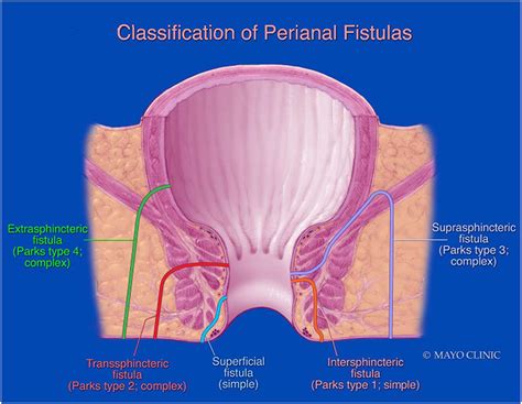 MR Imaging of Perianal Fistulas - Radiologic Clinics