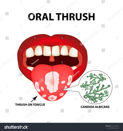Oral Thrush Candidiasis On Tongue Fungus: Hình minh họa có sẵn 1271265526 | Shutterstock