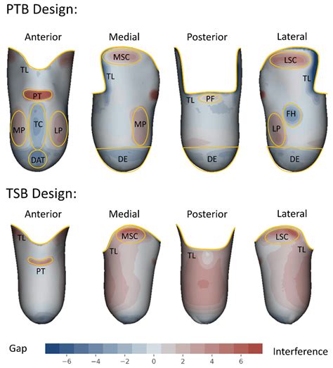 Types Of Transfemoral Sockets at Murray Baxter blog