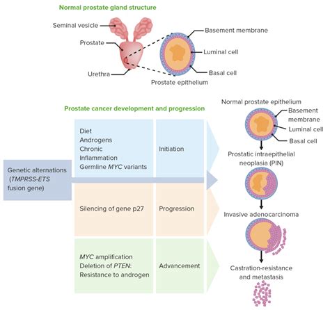 Adenocarcinoma Prostate Cancer