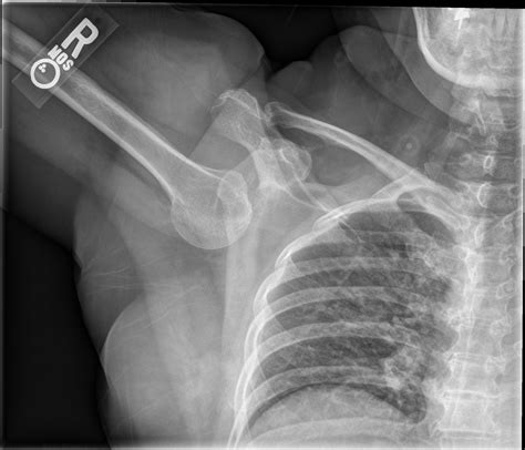 X Ray Shoulder Joint Dislocation at Paul Hunter blog