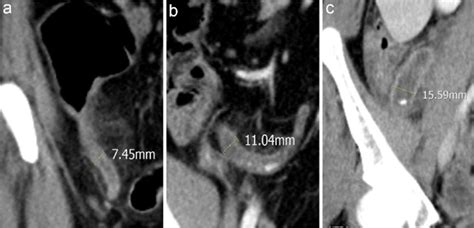 Image result for Normal Appendix Diameter