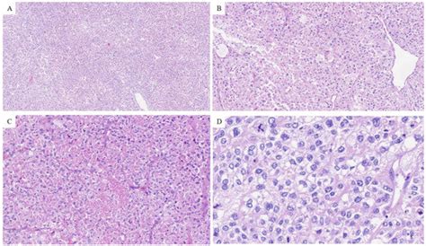 Adrenal Cortical Carcinoma with Inferior Vena Cava and Right Atrium ...