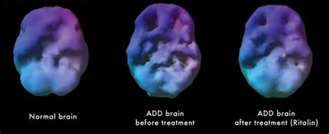 Image result for Add Brain Scan