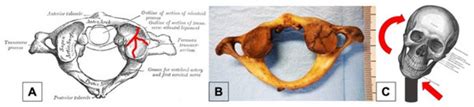 Assessment of Cervical Skeletal Trauma: The Synergistic Contribution of ...