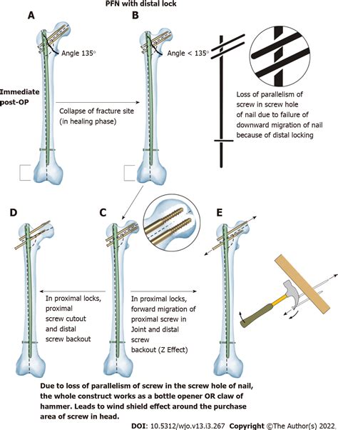 Intramedullary Nailing Simplified model of the IM nail (left) and the ...