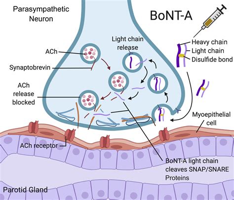 First bite syndrome treated with onabotulinumtoxin A injections - The ...