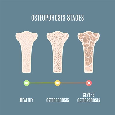 Stages Of Osteoporosis Pictures