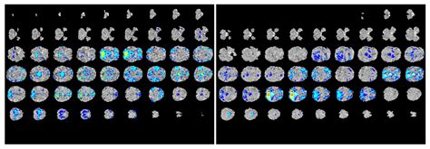 Deep Multimodal Learning for the Diagnosis of Autism Spectrum Disorder