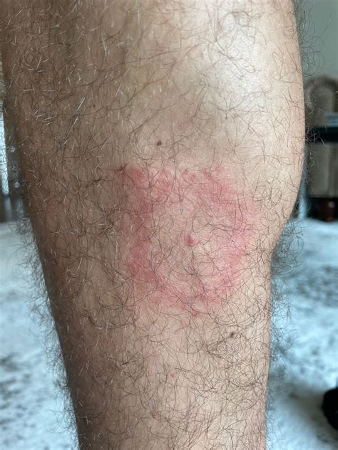 Round Itchy Rash On Lower Leg