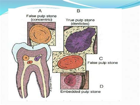 Image result for Pulp Extraction Tooth
