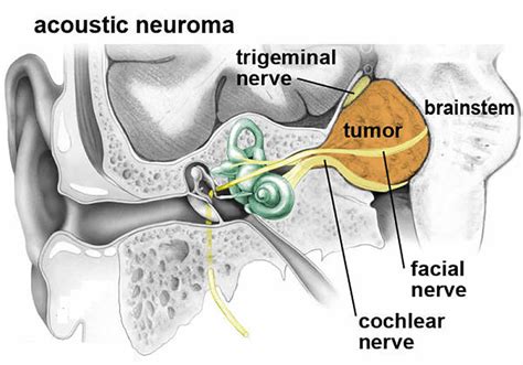 Acoustic Neuroma Treatment