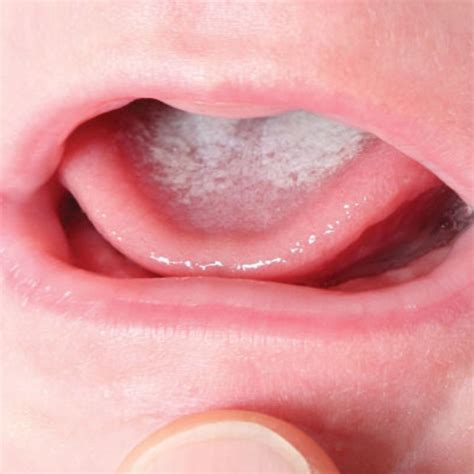 Complete Guide To Treating Thrush (Pictures) — Mattos Lactation ...