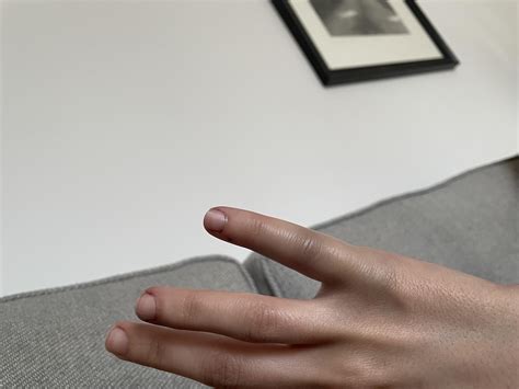 Bruised finger / ligament? : r/InjuriesAndWounds