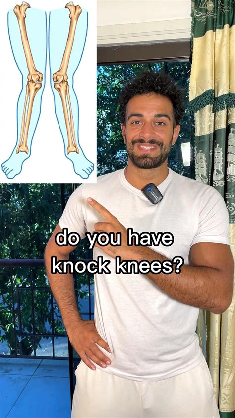 How to fix knock knees 12 at home methods – Artofit