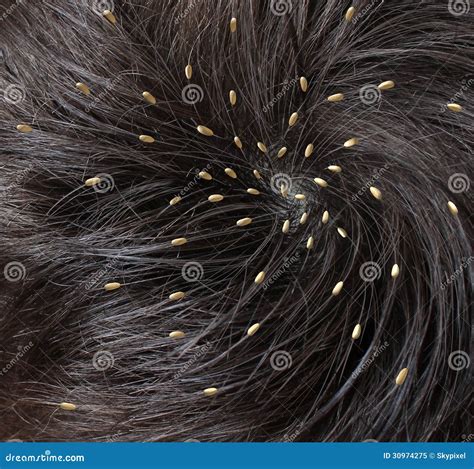 Head Lice stock illustration. Illustration of insect - 30974275