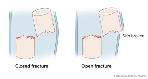 骨折 - ob欧宝体育app下载
