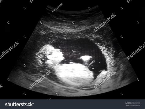 Ultrasound Film Thirteen Week Fetus Stock Photo 135950930 | Shutterstock