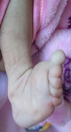 A true neonatal tail with limb defect - a rare case report | Pediatric ...