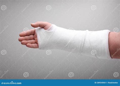 Broken arm bone in cast stock photo. Image of wrapped - 28954060
