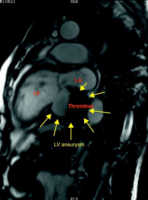 Left Ventricular Aneurysm