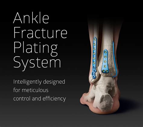 Ankle Fracture Plating System - Unite Foot and Ankle