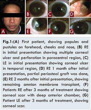Two Cases of Corneal Ulcer Caused by Ocular Rosacea: Late Versus Prompt ...