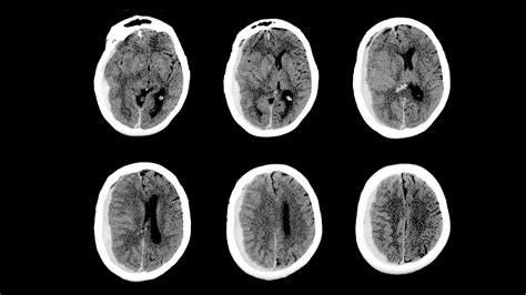 Subdural Hematoma