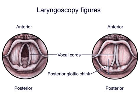 Vocal Cord Dysfunction — NUEM Blog