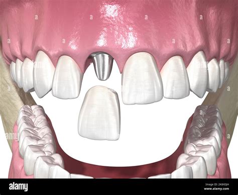Custom abutment, dental implant and ceramic crown. Medically accurate tooth 3D illustration ...