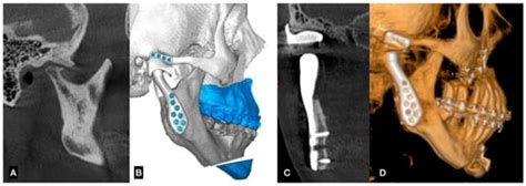 Long-Term Stability in Temporomandibular Joint Replacement: A Review of ...