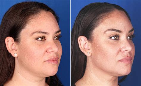Image result for Profound Face Procedure