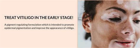 Fixderma Vitipause Gel for Vitiligo – Fixderma Skincare