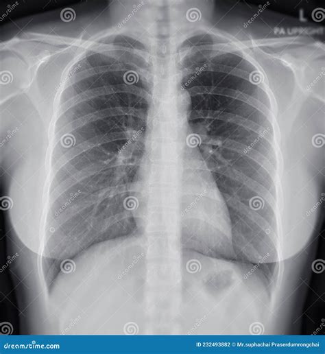 X Ray Chest Normal